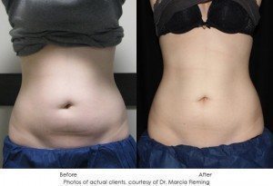 CoolSculpting-img1-10