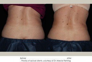 CoolSculpting-img10-1