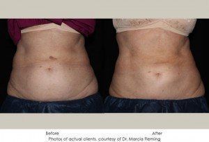 CoolSculpting-img11-1