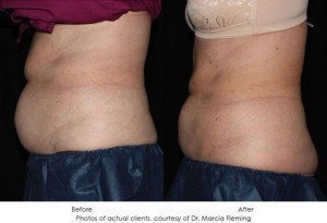 CoolSculpting-img12-1