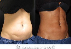 CoolSculpting-img13-1