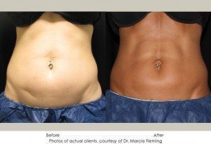 CoolSculpting-img14-1