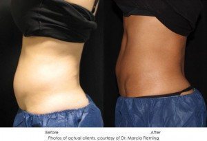 CoolSculpting-img15-1