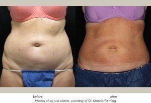 CoolSculpting-img16-1