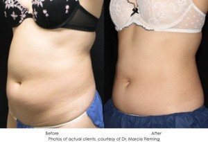 CoolSculpting-img18-1