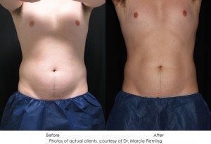 CoolSculpting-img2-10