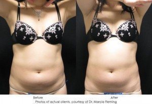 CoolSculpting-img20-1