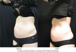 CoolSculpting-img21-1