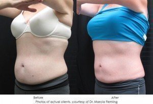 CoolSculpting-img22-1