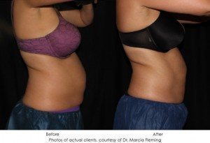 CoolSculpting-img24-1