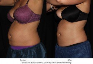 CoolSculpting-img25-1