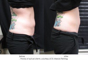 CoolSculpting-img26-1