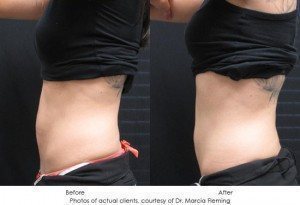 CoolSculpting-img28-1