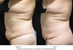 CoolSculpting-img29-1