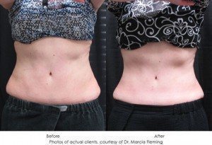 CoolSculpting-img3-1