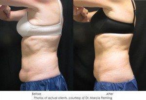 CoolSculpting-img4-1