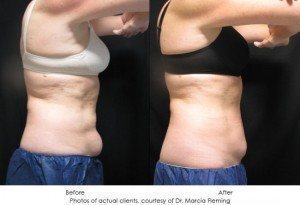 CoolSculpting-img6-1