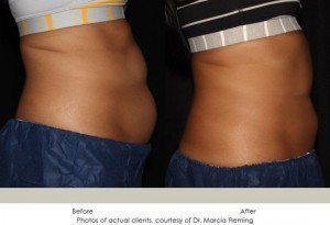 CoolSculpting-img7-1