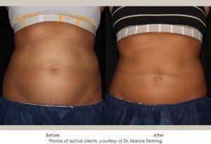 CoolSculpting-img8-1