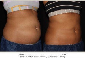 CoolSculpting-img9-1