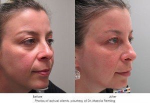 HydraFacial-2-300x205