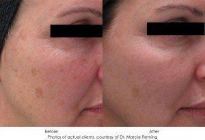 Photorejuvenation-img10