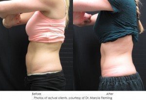 coolsculpting-img26