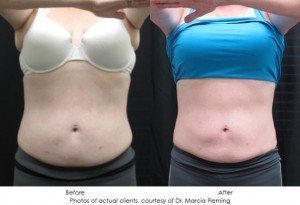 coolsculpting-img4