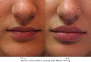 dermal-fillers-img1-10