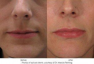 dermal-fillers-img10