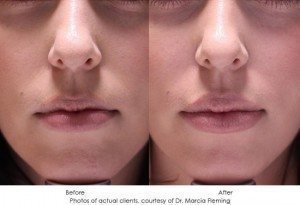 dermal-fillers-img11-1