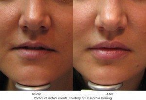 dermal-fillers-img12-1