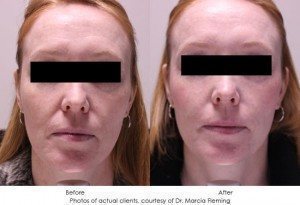 dermal-fillers-img13-1