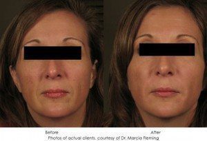 dermal-fillers-img13