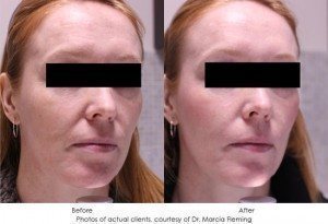 dermal-fillers-img14-1