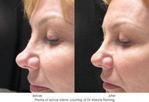 dermal-fillers-img14