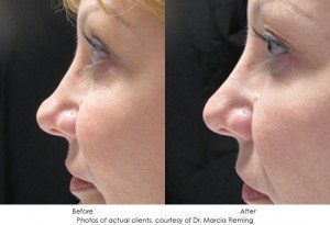 dermal-fillers-img15