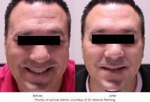 dermal-fillers-img17-1