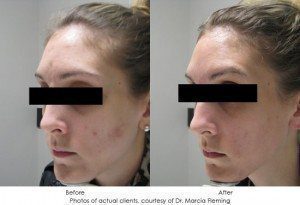 dermal-fillers-img17