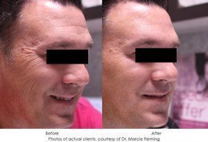 dermal-fillers-img18-1