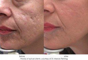 dermal-fillers-img18