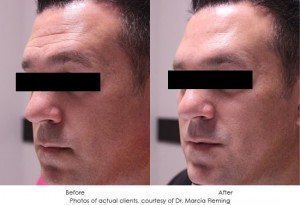 dermal-fillers-img19-1