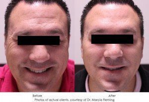 dermal-fillers-img22