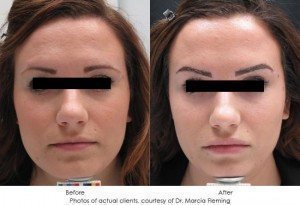 dermal-fillers-img23-1