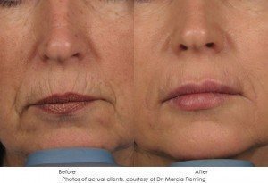 dermal-fillers-img25-1