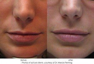 dermal-fillers-img3-1