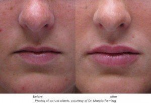 dermal-fillers-img4-1