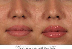 dermal-fillers-img7-2