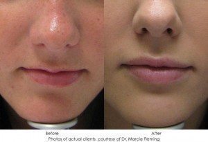 dermal-fillers-img8-1