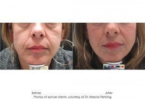 dermal-fillers-img9-1